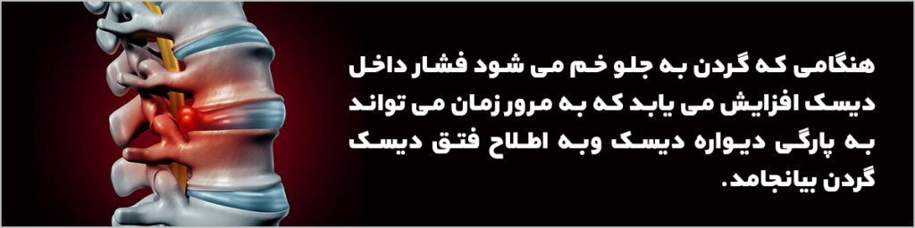 فتق دیسک گردن